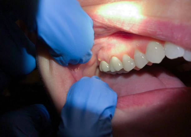 Best Teeth Whitening  in Opelousas, LA