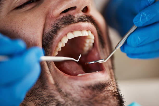 Best Knocked-Out Tooth Emergency  in Opelousas, LA